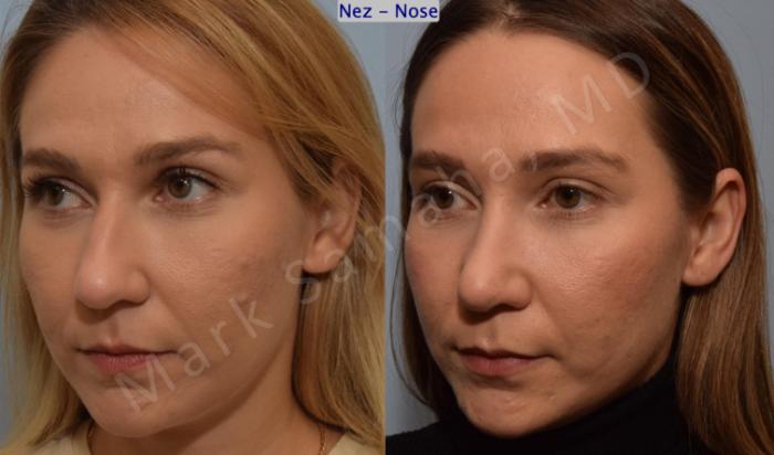 Before & After Rhinoplastie / Rhinoplasty Case 194 Left Oblique View in Montreal, QC