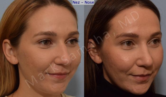 Before & After Rhinoplastie / Rhinoplasty Case 194 Right Oblique Smile  View in Montreal, QC