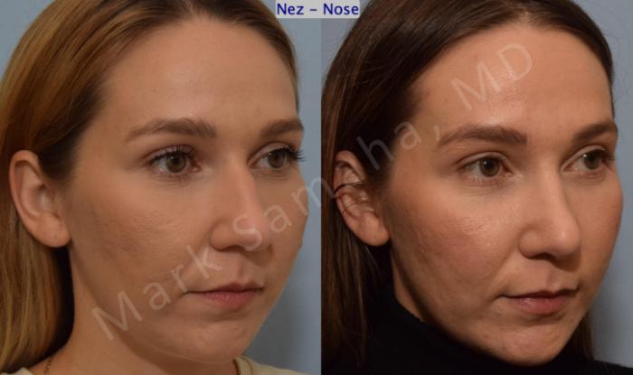 Before & After Rhinoplastie / Rhinoplasty Case 194 Right Oblique View in Montreal, QC