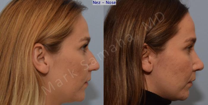 Before & After Rhinoplastie / Rhinoplasty Case 194 Right Side View in Montreal, QC