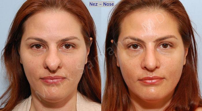 Before & After Rhinoplastie / Rhinoplasty Case 34 View #2 View in Montreal, QC