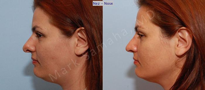 Before & After Rhinoplastie / Rhinoplasty Case 34 View #3 View in Montreal, QC
