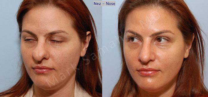Before & After Rhinoplastie / Rhinoplasty Case 34 View #4 View in Montreal, QC