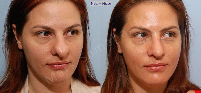 Before & After Rhinoplastie / Rhinoplasty Case 34 View #5 View in Montreal, QC