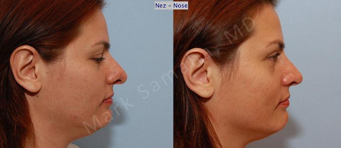 Before & After Rhinoplastie / Rhinoplasty Case 34 View #6 View in Montreal, QC