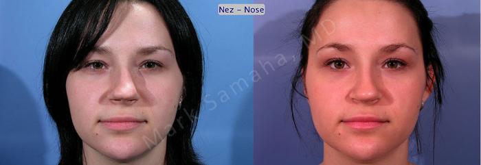 Before & After Rhinoplastie / Rhinoplasty Case 35 View #1 View in Mount Royal, QC