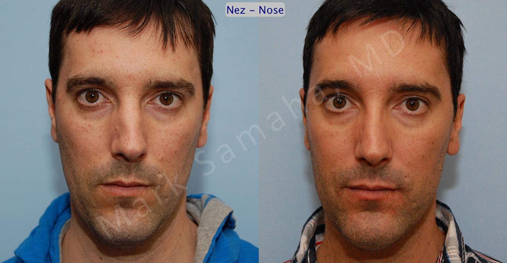 Before & After Rhinoplastie / Rhinoplasty Case 36 View #1 View in Montreal, QC