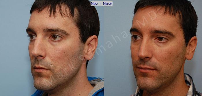 Before & After Rhinoplastie / Rhinoplasty Case 36 View #2 View in Montreal, QC