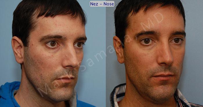 Before & After Rhinoplastie / Rhinoplasty Case 36 View #3 View in Montreal, QC