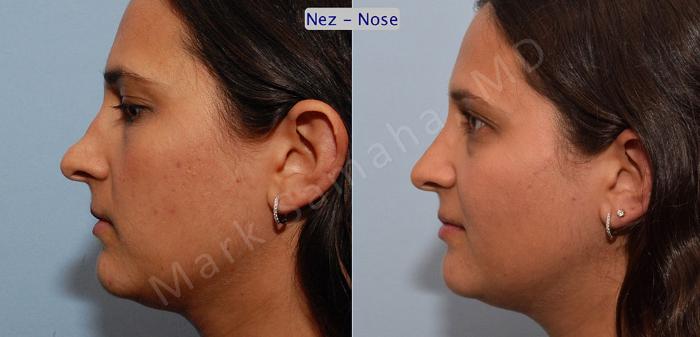 Before & After Rhinoplastie / Rhinoplasty Case 37 View #1 View in Montreal, QC