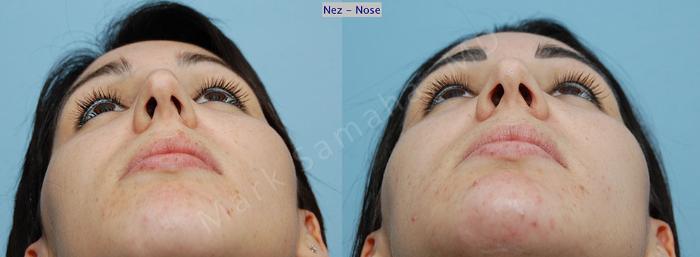 Before & After Rhinoplastie / Rhinoplasty Case 38 View #1 View in Mount Royal, QC