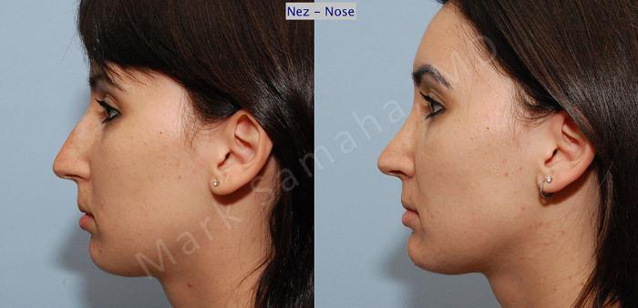 Before & After Rhinoplastie / Rhinoplasty Case 38 View #2 View in Montreal, QC
