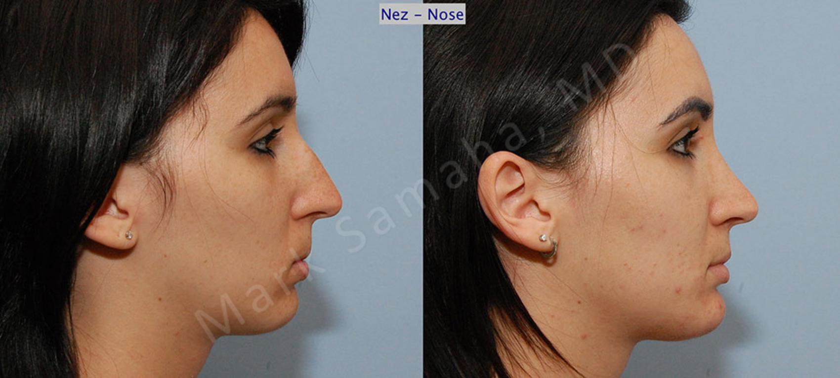 Before & After Rhinoplastie / Rhinoplasty Case 38 View #3 View in Montreal, QC