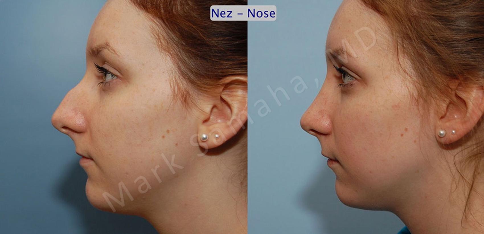 Before & After Rhinoplastie / Rhinoplasty Case 39 View #1 View in Montreal, QC