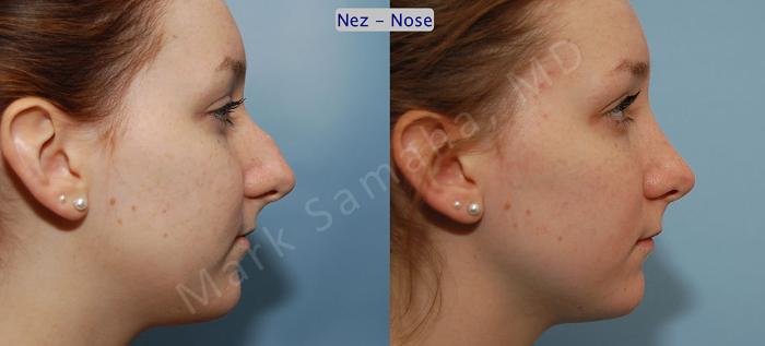 Before & After Rhinoplastie / Rhinoplasty Case 39 View #2 View in Montreal, QC