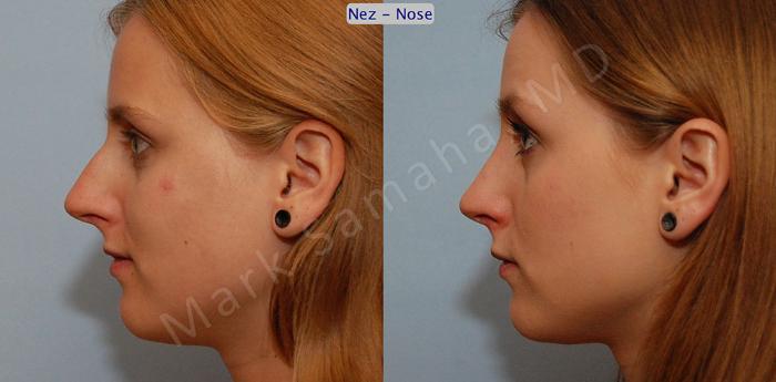 Before & After Rhinoplastie / Rhinoplasty Case 40 View #1 View in Mount Royal, QC
