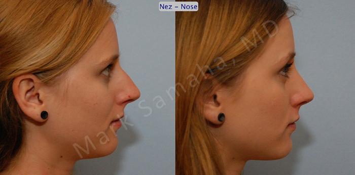Before & After Rhinoplastie / Rhinoplasty Case 40 View #2 View in Montreal, QC