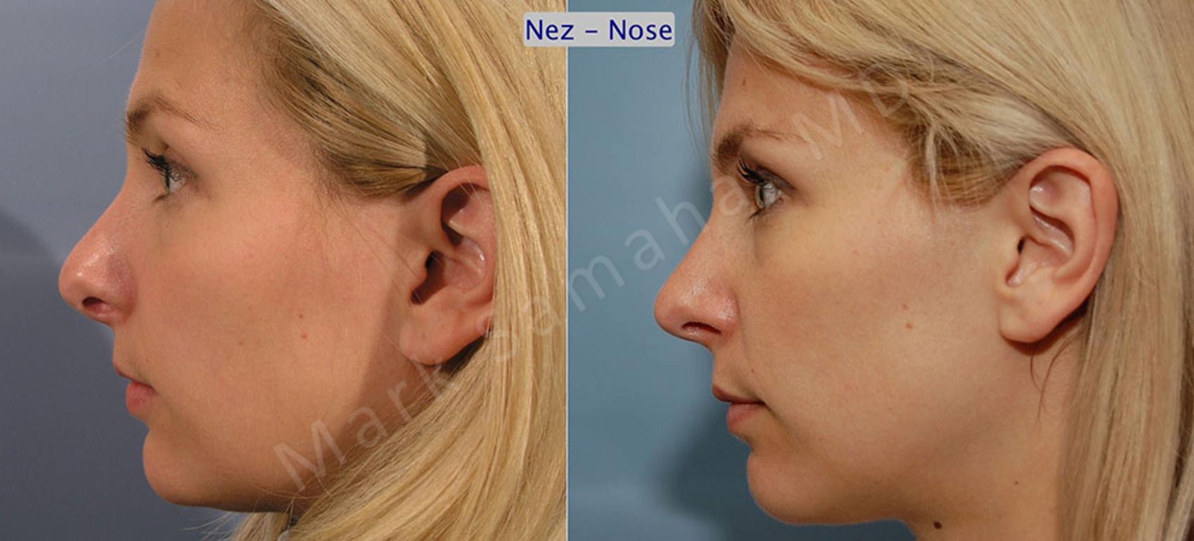 Before & After Rhinoplastie / Rhinoplasty Case 41 View #1 View in Montreal, QC