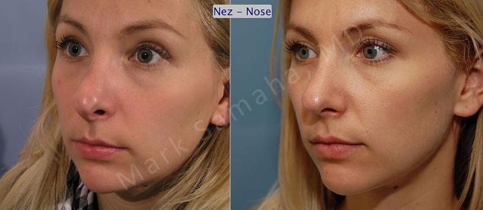 Before & After Rhinoplastie / Rhinoplasty Case 41 View #2 View in Montreal, QC