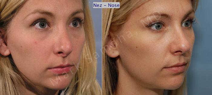 Before & After Rhinoplastie / Rhinoplasty Case 41 View #3 View in Montreal, QC
