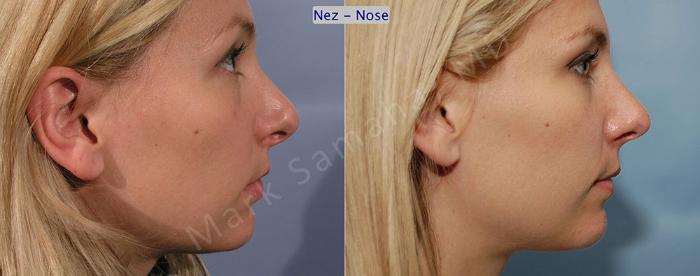 Before & After Rhinoplastie / Rhinoplasty Case 41 View #4 View in Montreal, QC