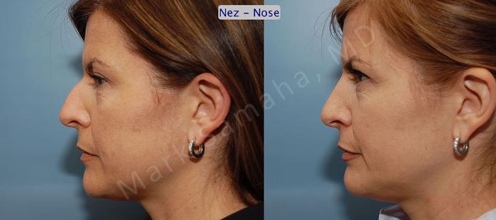 Before & After Rhinoplastie / Rhinoplasty Case 42 View #1 View in Montreal, QC