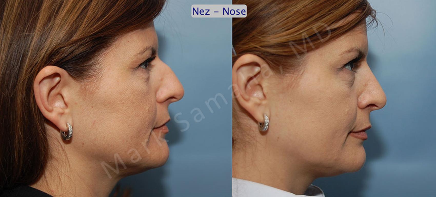 Before & After Rhinoplastie / Rhinoplasty Case 42 View #2 View in Montreal, QC