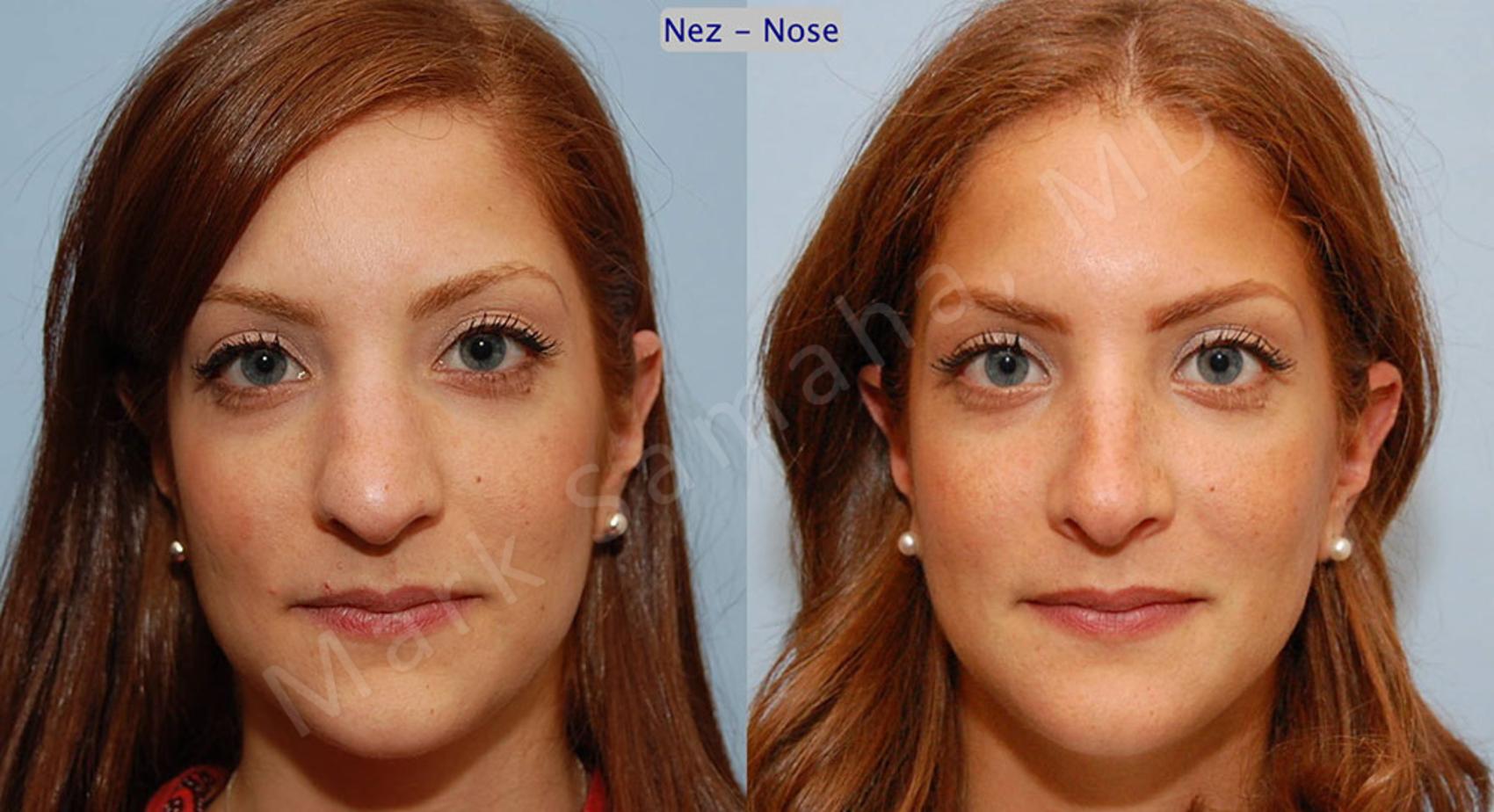 Before & After Rhinoplastie / Rhinoplasty Case 43 View #1 View in Mount Royal, QC