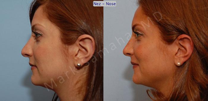 Before & After Rhinoplastie / Rhinoplasty Case 43 View #2 View in Mount Royal, QC
