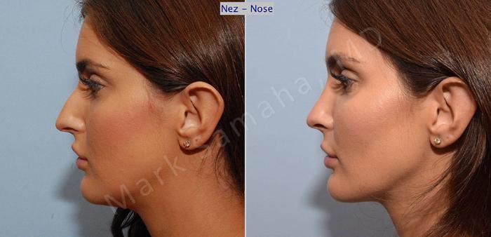 Before & After Rhinoplastie / Rhinoplasty Case 45 View #1 View in Montreal, QC