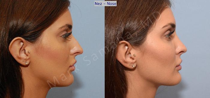 Before & After Rhinoplastie / Rhinoplasty Case 45 View #2 View in Montreal, QC