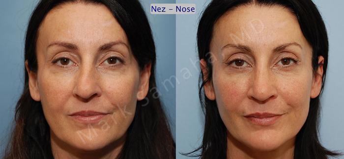 Before & After Rhinoplastie / Rhinoplasty Case 46 View #1 View in Montreal, QC