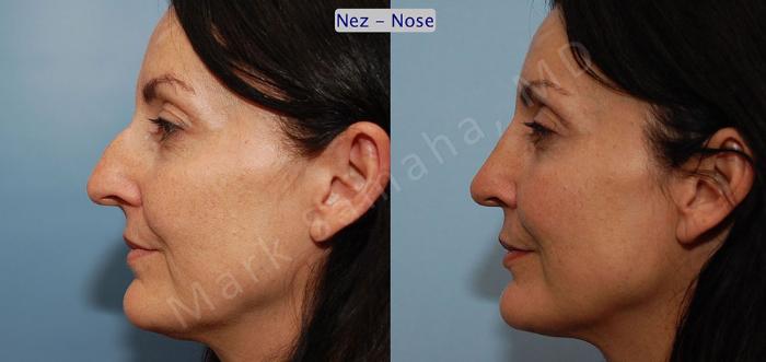 Before & After Rhinoplastie / Rhinoplasty Case 46 View #2 View in Montreal, QC