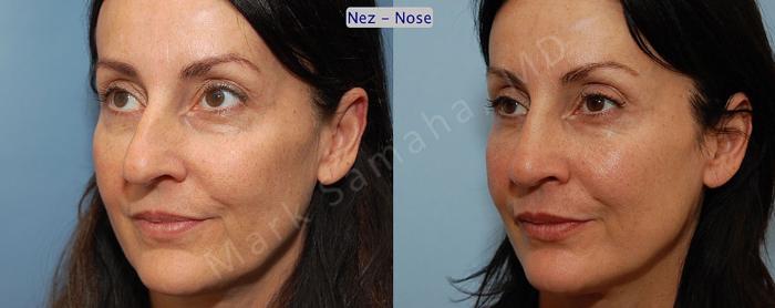 Before & After Rhinoplastie / Rhinoplasty Case 46 View #3 View in Montreal, QC