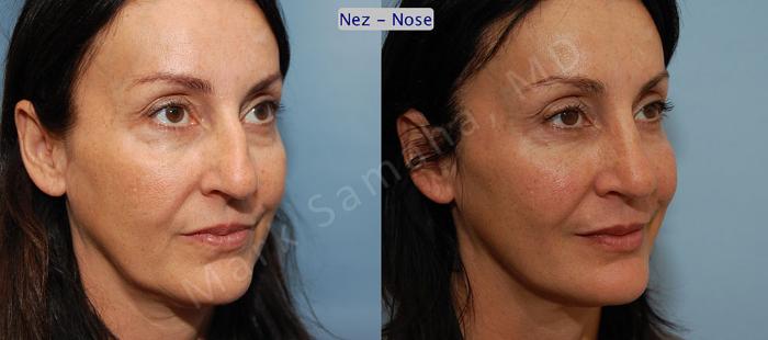 Before & After Rhinoplastie / Rhinoplasty Case 46 View #4 View in Montreal, QC