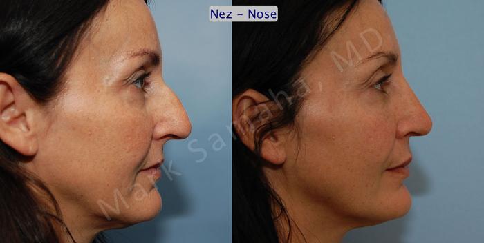 Before & After Rhinoplastie / Rhinoplasty Case 46 View #5 View in Montreal, QC