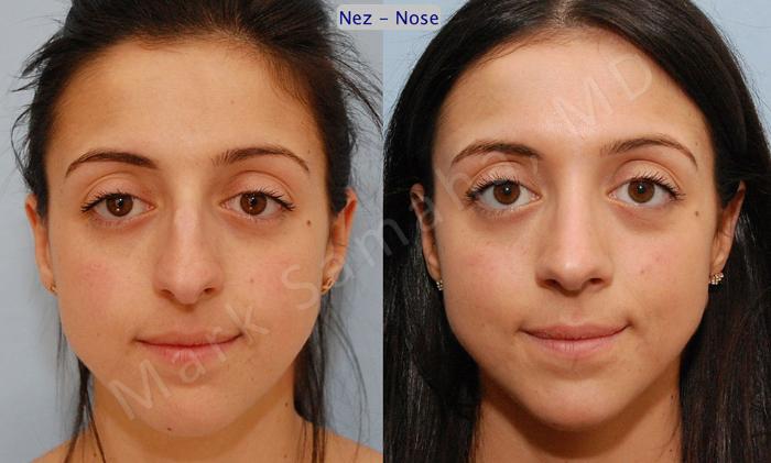 Before & After Rhinoplastie / Rhinoplasty Case 47 View #1 View in Montreal, QC