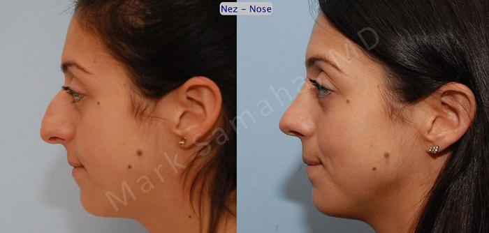 Before & After Rhinoplastie / Rhinoplasty Case 47 View #2 View in Montreal, QC