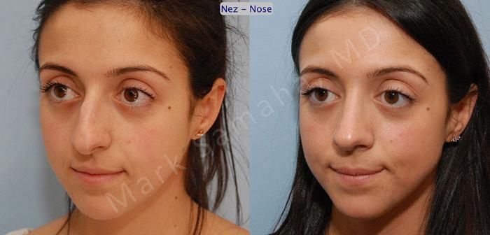Before & After Rhinoplastie / Rhinoplasty Case 47 View #3 View in Montreal, QC