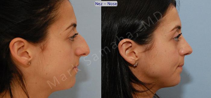 Before & After Rhinoplastie / Rhinoplasty Case 47 View #5 View in Montreal, QC