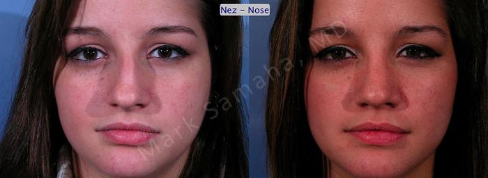 Before & After Rhinoplastie / Rhinoplasty Case 48 View #1 View in Montreal, QC