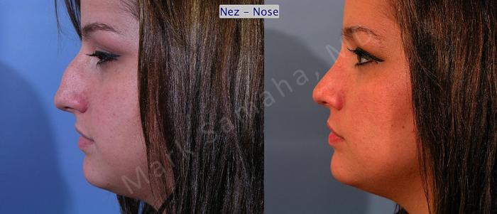Before & After Rhinoplastie / Rhinoplasty Case 48 View #2 View in Montreal, QC