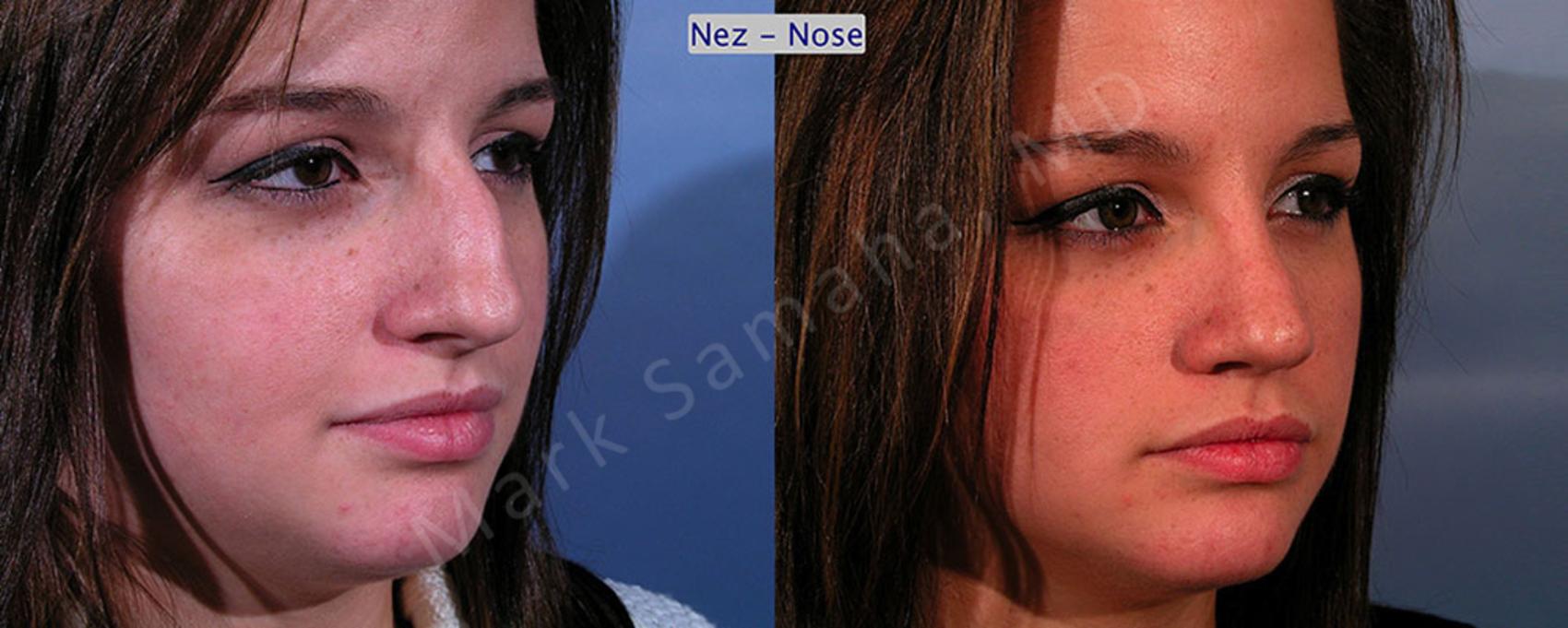 Before & After Rhinoplastie / Rhinoplasty Case 48 View #3 View in Montreal, QC