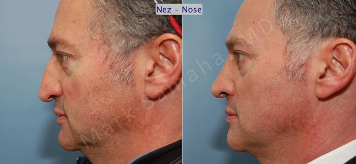 Before & After Rhinoplastie / Rhinoplasty Case 49 View #1 View in Montreal, QC