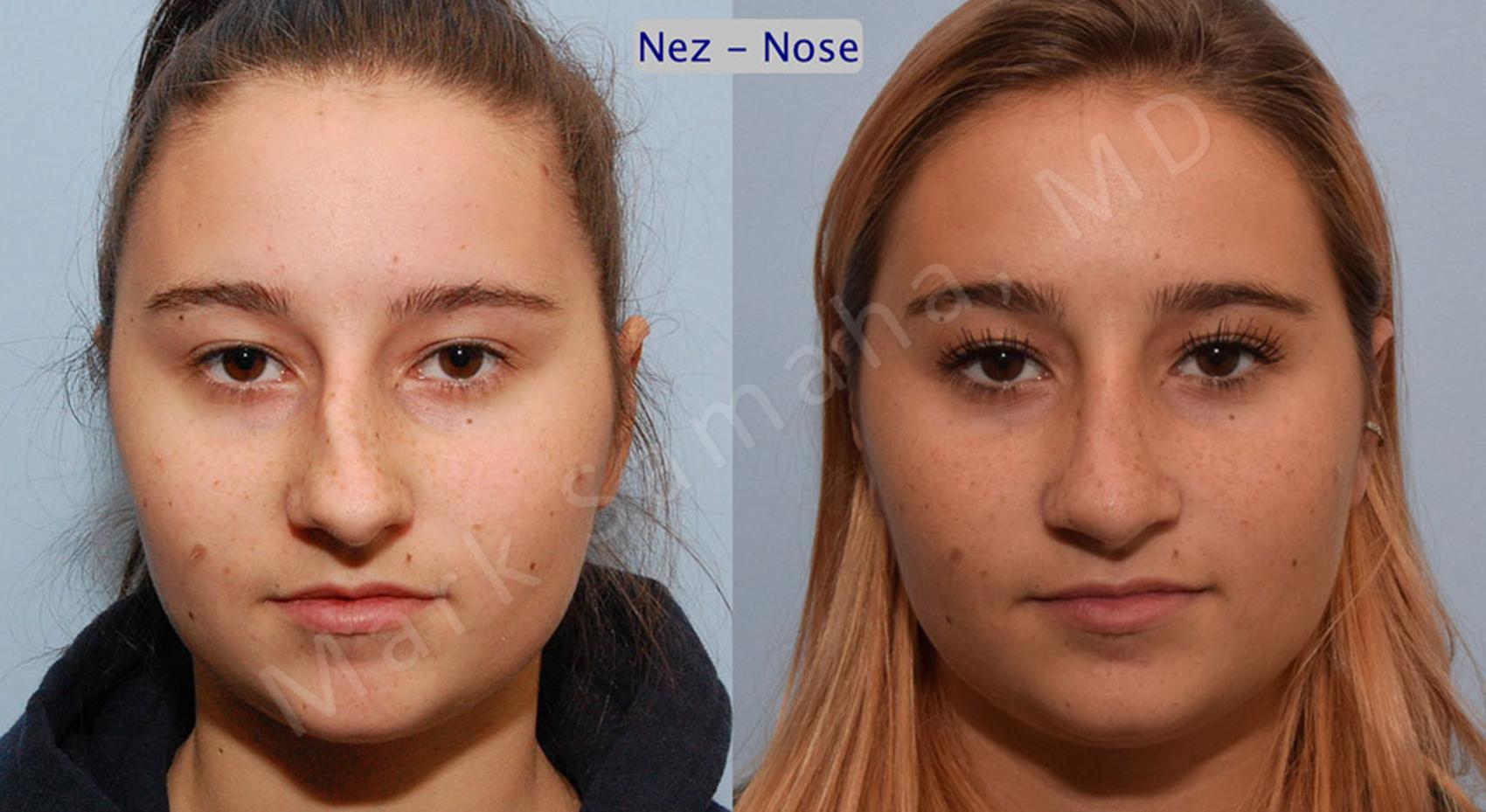 Before & After Rhinoplastie / Rhinoplasty Case 50 View #1 View in Montreal, QC
