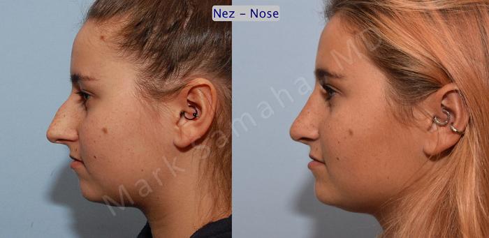 Before & After Rhinoplastie / Rhinoplasty Case 50 View #2 View in Montreal, QC