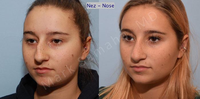 Before & After Rhinoplastie / Rhinoplasty Case 50 View #3 View in Montreal, QC