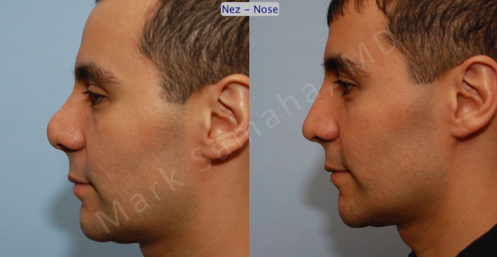 Before & After Rhinoplastie / Rhinoplasty Case 51 View #1 View in Montreal, QC