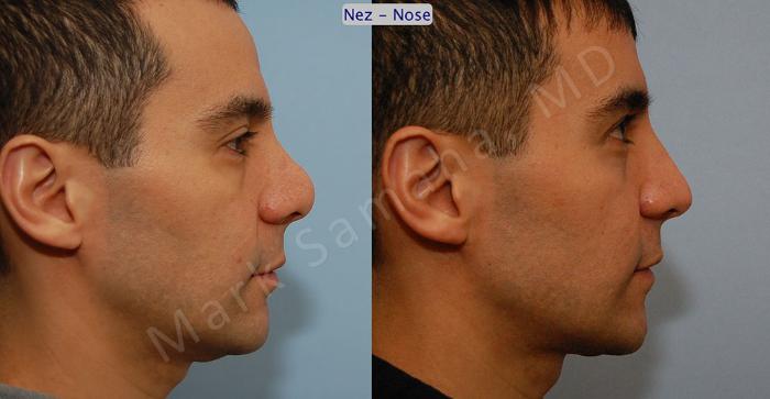 Before & After Rhinoplastie / Rhinoplasty Case 51 View #2 View in Montreal, QC