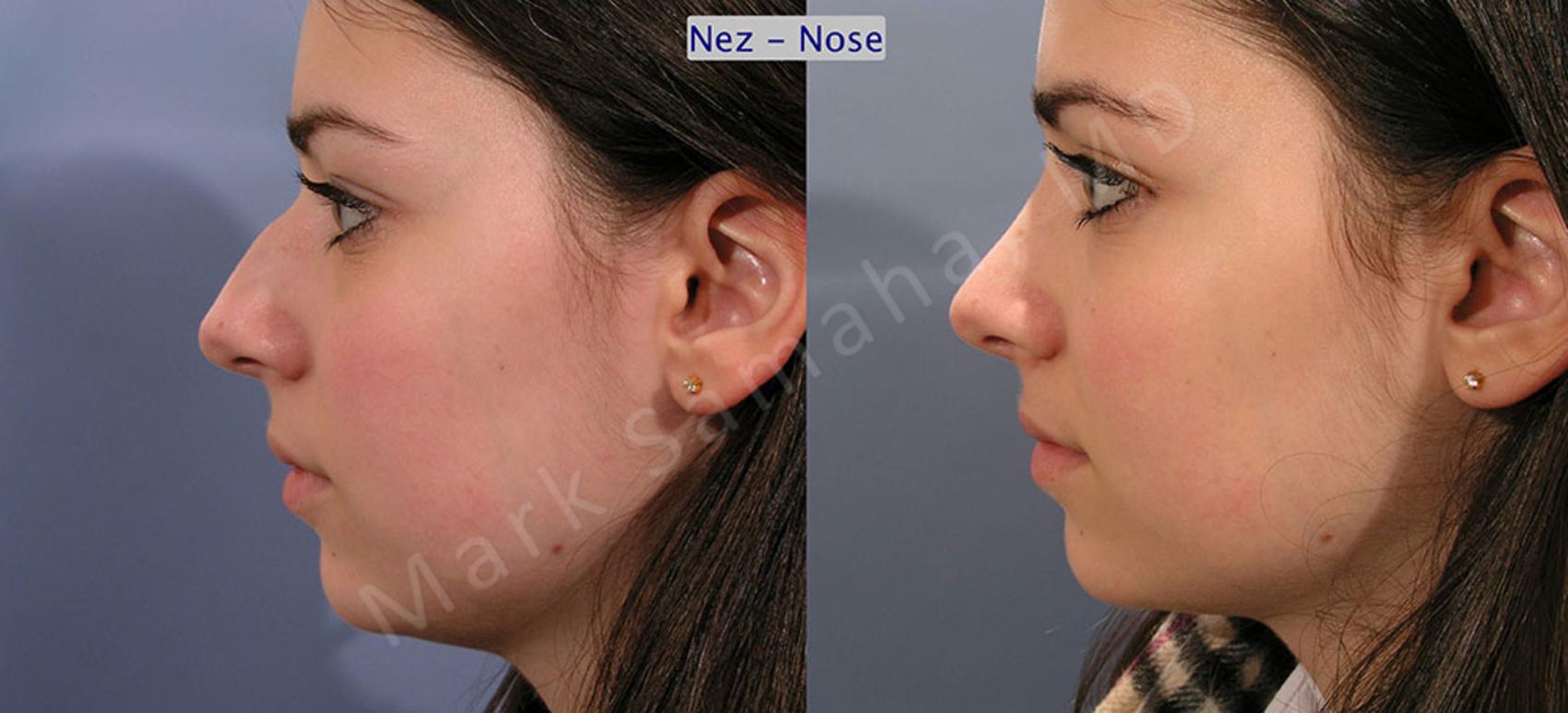 Before & After Rhinoplastie / Rhinoplasty Case 52 View #1 View in Mount Royal, QC